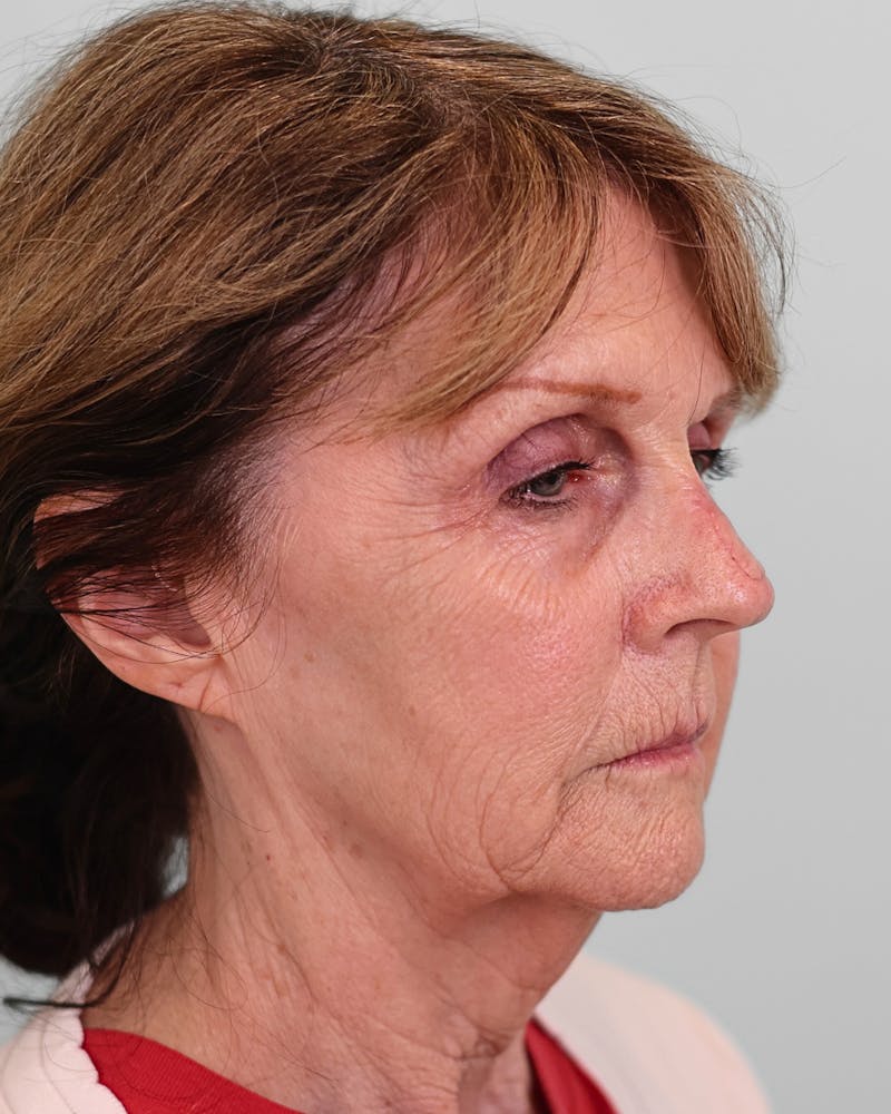 Facelift Before & After Gallery - Patient 268516 - Image 7