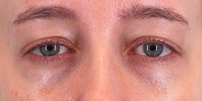 Winged Blepharoplasty Before & After Gallery - Patient 679305 - Image 1