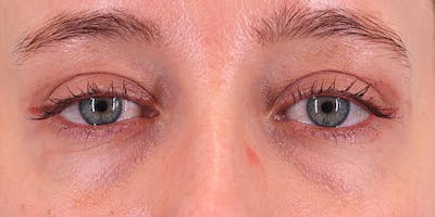 Winged Blepharoplasty Before & After Gallery - Patient 679305 - Image 2