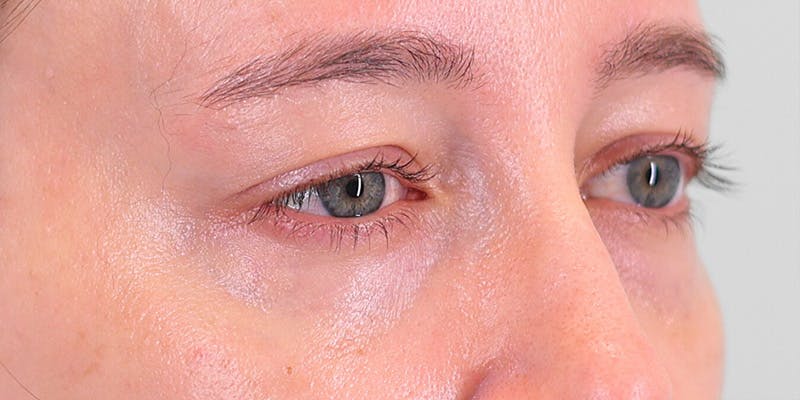Winged Blepharoplasty Before & After Gallery - Patient 679305 - Image 3