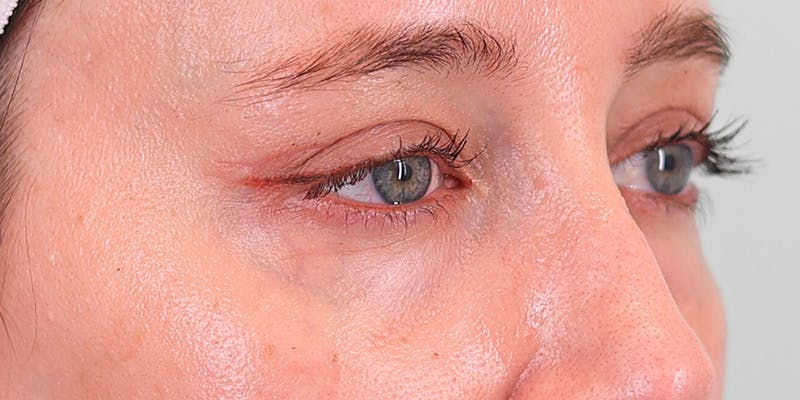 Winged Blepharoplasty Before & After Gallery - Patient 679305 - Image 4
