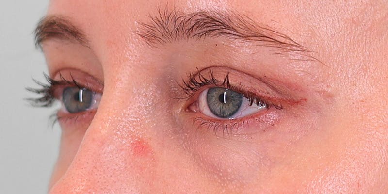 Winged Blepharoplasty Before & After Gallery - Patient 679305 - Image 6