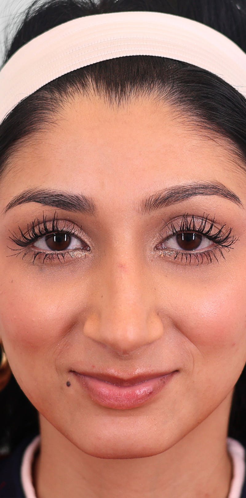 Rhinoplasty Before & After Gallery - Patient 123246 - Image 6