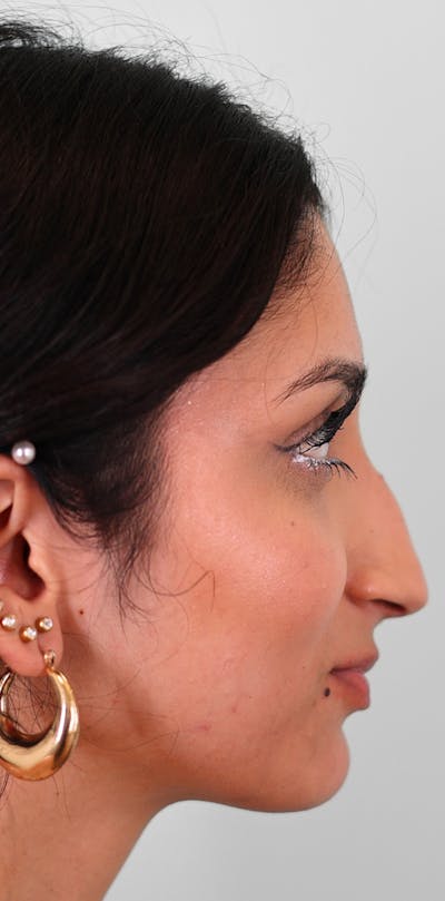 Rhinoplasty Before & After Gallery - Patient 123246 - Image 1
