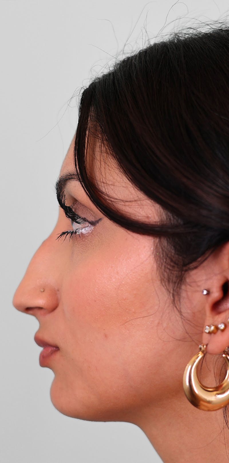 Rhinoplasty Before & After Gallery - Patient 123246 - Image 3