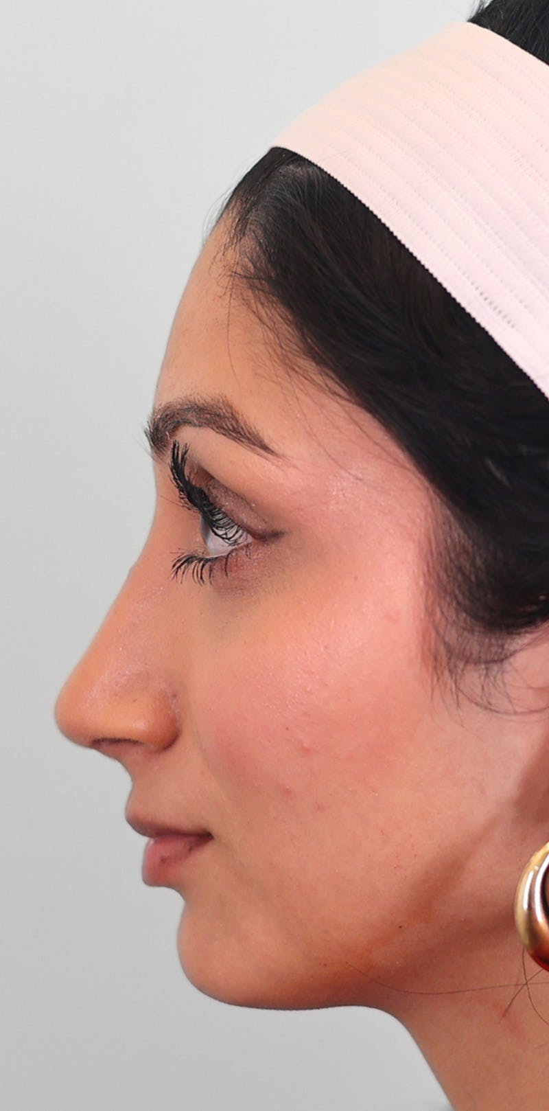 Rhinoplasty Before & After Gallery - Patient 123246 - Image 4