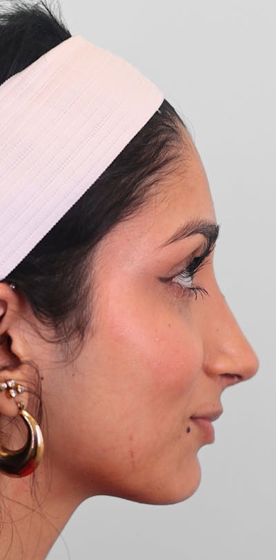 Rhinoplasty Before & After Gallery - Patient 123246 - Image 2