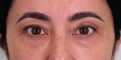 Winged Blepharoplasty Before & After Gallery - Patient 157821 - Image 1
