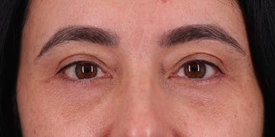 Winged Blepharoplasty Before & After Gallery - Patient 157821 - Image 2