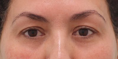 Winged Blepharoplasty Before & After Gallery - Patient 350666 - Image 1