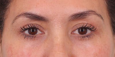 Winged Blepharoplasty Before & After Gallery - Patient 350666 - Image 2
