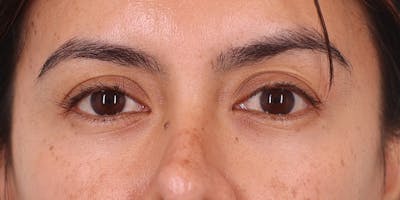 Winged Blepharoplasty Before & After Gallery - Patient 381873 - Image 1