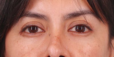 Winged Blepharoplasty Before & After Gallery - Patient 381873 - Image 2