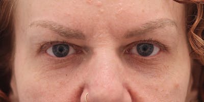 Winged Blepharoplasty Before & After Gallery - Patient 233300 - Image 1