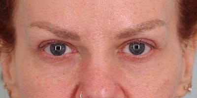 Winged Blepharoplasty Before & After Gallery - Patient 233300 - Image 2