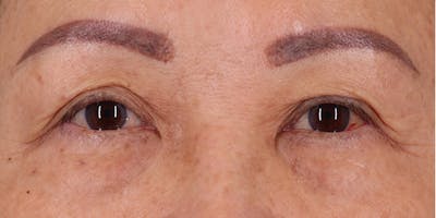 Winged Blepharoplasty Before & After Gallery - Patient 106425 - Image 1