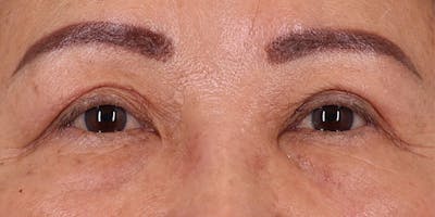 Winged Blepharoplasty Before & After Gallery - Patient 106425 - Image 2
