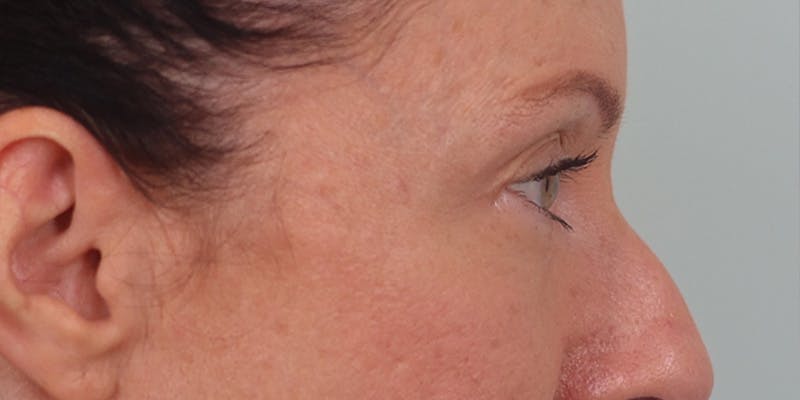 Winged Blepharoplasty Before & After Gallery - Patient 337985 - Image 3