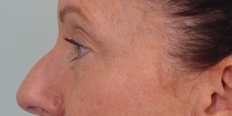 Winged Blepharoplasty Before & After Gallery - Patient 337985 - Image 5