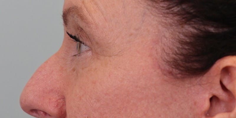 Winged Blepharoplasty Before & After Gallery - Patient 337985 - Image 6