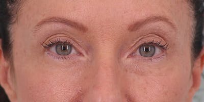 Winged Blepharoplasty Before & After Gallery - Patient 337985 - Image 1