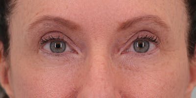 Winged Blepharoplasty Before & After Gallery - Patient 337985 - Image 2