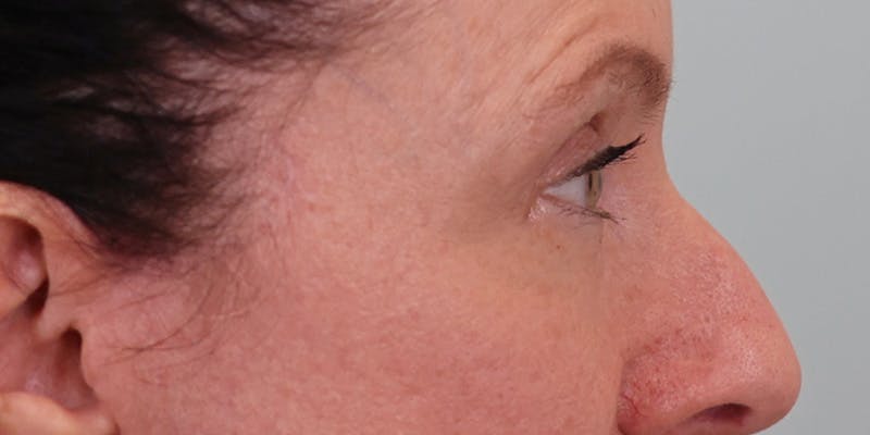 Winged Blepharoplasty Before & After Gallery - Patient 337985 - Image 4