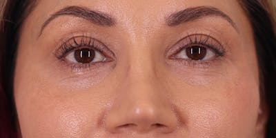 Winged Blepharoplasty Before & After Gallery - Patient 194525 - Image 1