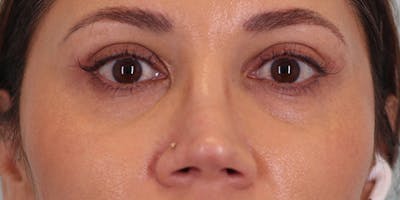 Winged Blepharoplasty Before & After Gallery - Patient 194525 - Image 2