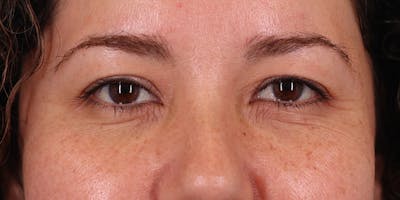 Winged Blepharoplasty Before & After Gallery - Patient 323101 - Image 1