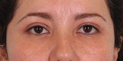 Winged Blepharoplasty Before & After Gallery - Patient 323101 - Image 2