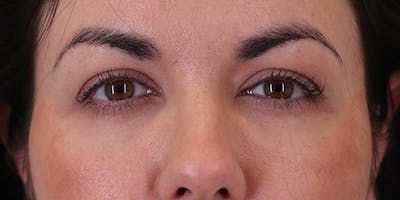 Winged Blepharoplasty Before & After Gallery - Patient 406658 - Image 1