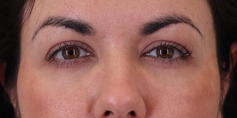 Winged Blepharoplasty Before & After Gallery - Patient 406658 - Image 1