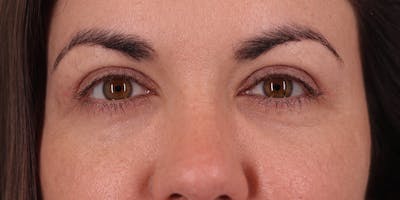 Winged Blepharoplasty Before & After Gallery - Patient 406658 - Image 2