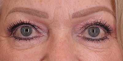 Winged Blepharoplasty Before & After Gallery - Patient 688474 - Image 1