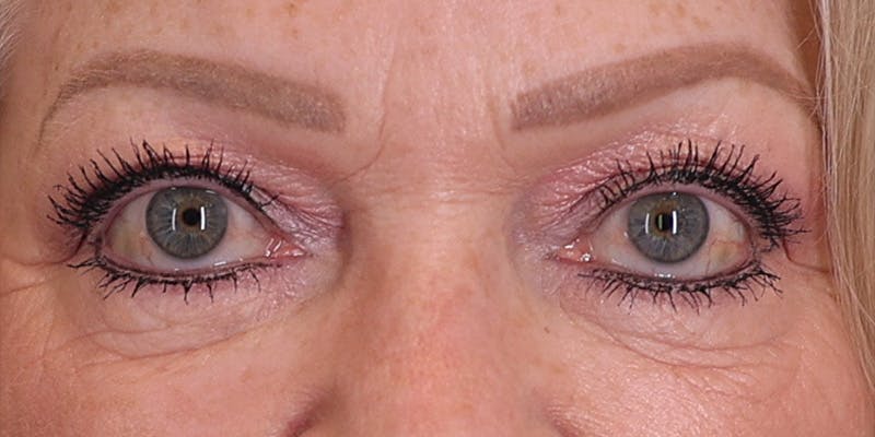 Winged Blepharoplasty Before & After Gallery - Patient 688474 - Image 1