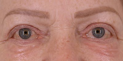 Winged Blepharoplasty Before & After Gallery - Patient 688474 - Image 2