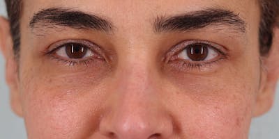 Winged Blepharoplasty Before & After Gallery - Patient 382845 - Image 1