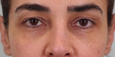 Winged Blepharoplasty Before & After Gallery - Patient 382845 - Image 2