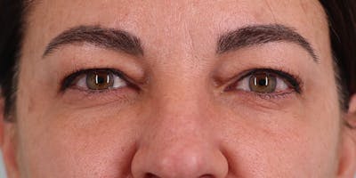 Winged Blepharoplasty Before & After Gallery - Patient 317651 - Image 1