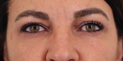 Winged Blepharoplasty Before & After Gallery - Patient 317651 - Image 2
