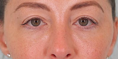 Winged Blepharoplasty Before & After Gallery - Patient 139397 - Image 1