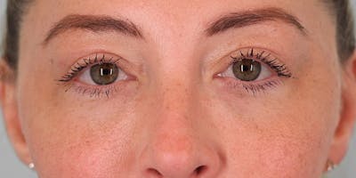 Winged Blepharoplasty Before & After Gallery - Patient 139397 - Image 2