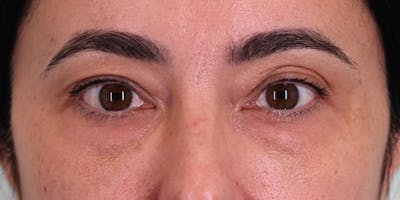 Winged Blepharoplasty Before & After Gallery - Patient 253936 - Image 1