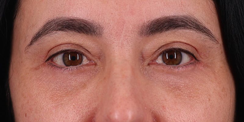 Winged Blepharoplasty Before & After Gallery - Patient 253936 - Image 2