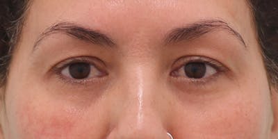 Winged Blepharoplasty Before & After Gallery - Patient 189967 - Image 1