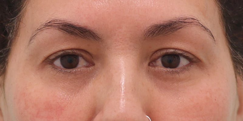 Winged Blepharoplasty Before & After Gallery - Patient 189967 - Image 1