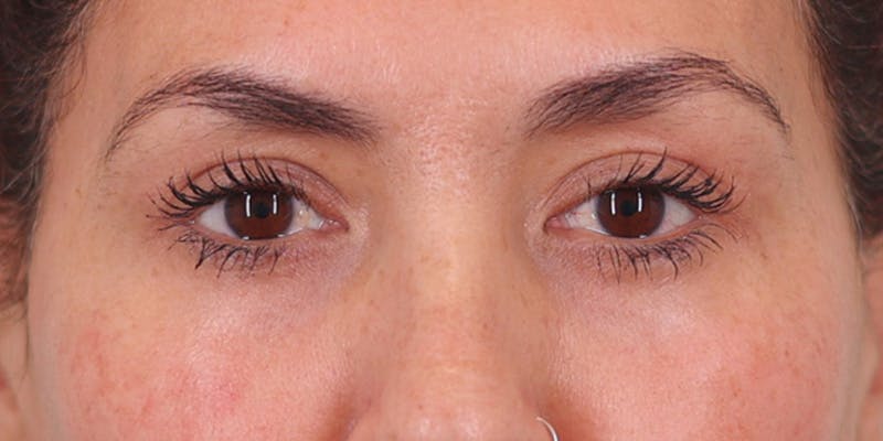 Winged Blepharoplasty Before & After Gallery - Patient 189967 - Image 2
