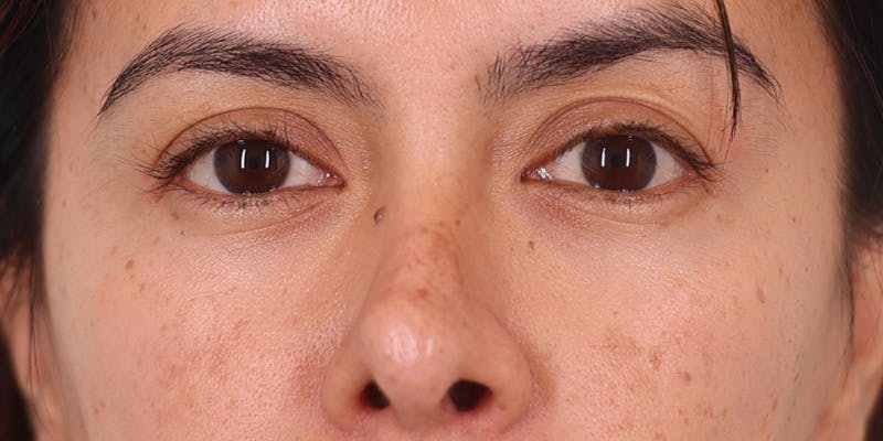 Winged Blepharoplasty Before & After Gallery - Patient 198615 - Image 1