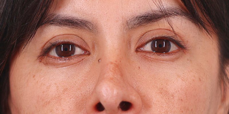 Winged Blepharoplasty Before & After Gallery - Patient 198615 - Image 2